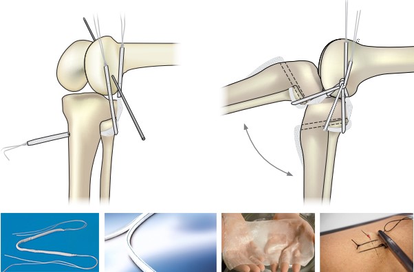 Implantable Medical Textiles | Artificial Ligament | Artificial Skin | Vascular Graft